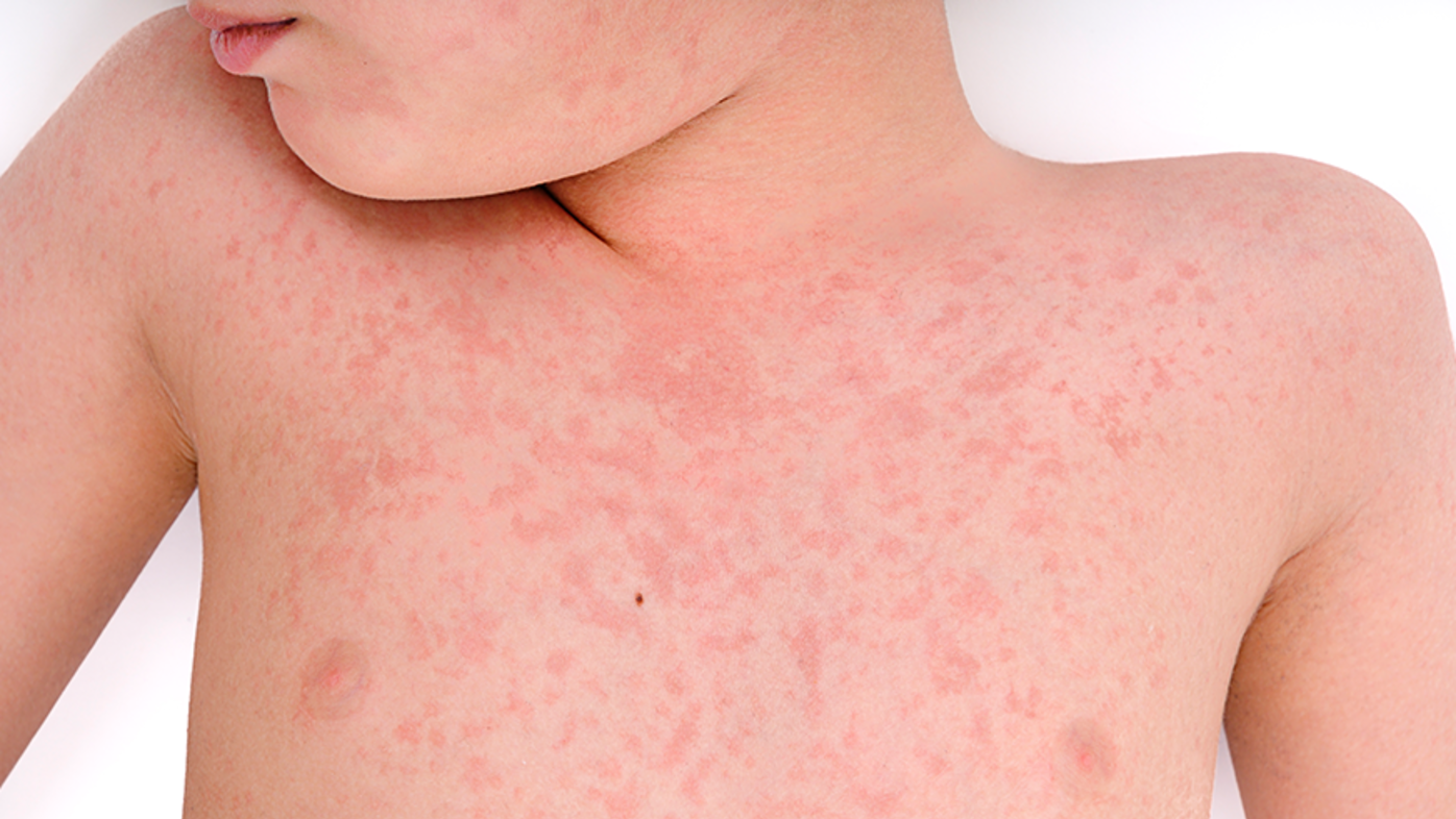 Potvrđena tri slučaja morbila u Sarajevu